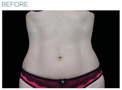 Emsculpt Abdomen Before & After Gallery - Patient 606039 - Image 1