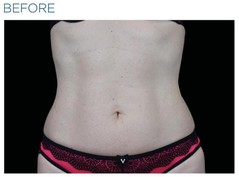 Emsculpt Abdomen Before & After Gallery - Patient 606039 - Image 1