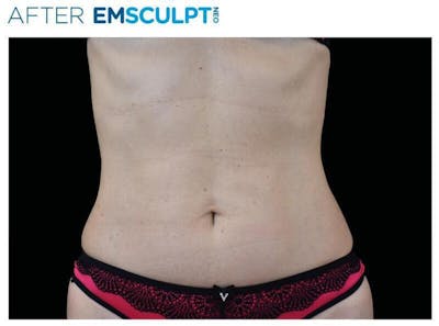 Emsculpt Abdomen Before & After Gallery - Patient 606039 - Image 2