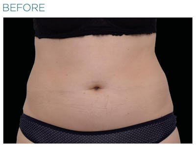 Emsculpt Abdomen Before & After Gallery - Patient 144717 - Image 1