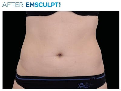 Emsculpt Abdomen Before & After Gallery - Patient 144717 - Image 2