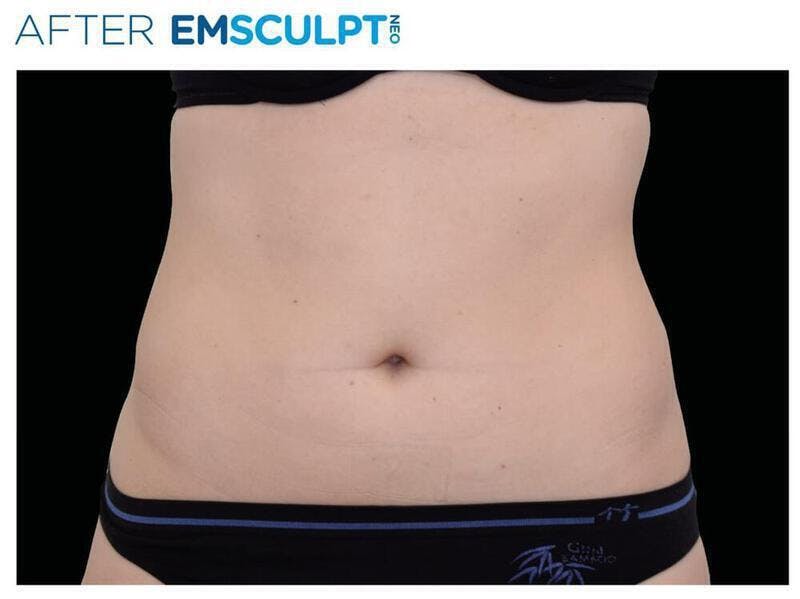 Emsculpt Abdomen Before & After Gallery - Patient 144717 - Image 2
