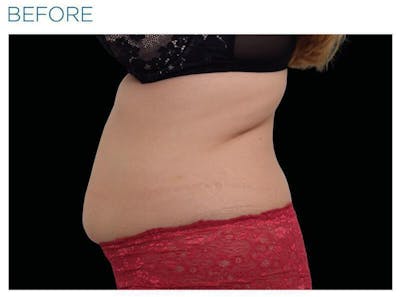 Emsculpt Abdomen Before & After Gallery - Patient 321655 - Image 1