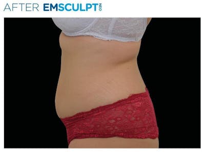 Emsculpt Abdomen Before & After Gallery - Patient 321655 - Image 2