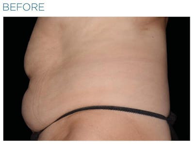 Emsculpt Abdomen Before & After Gallery - Patient 131477 - Image 1