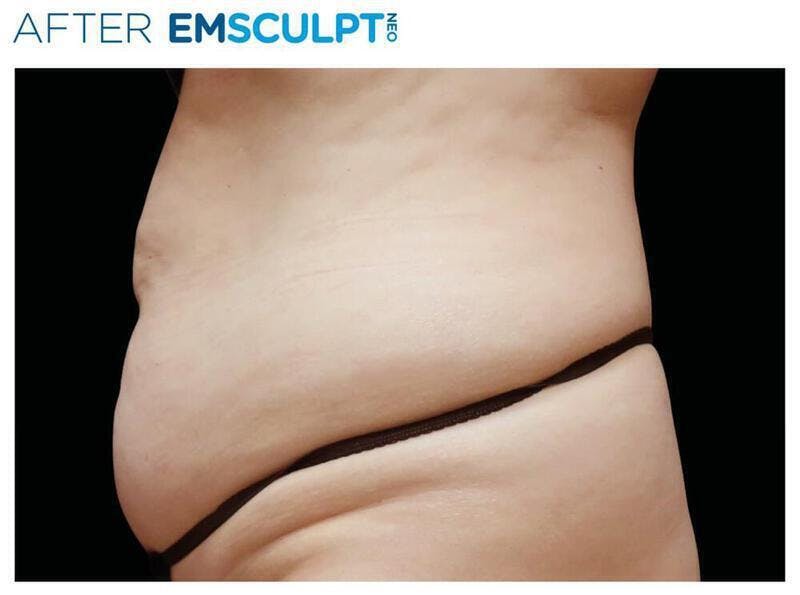 Emsculpt Abdomen Before & After Gallery - Patient 131477 - Image 2