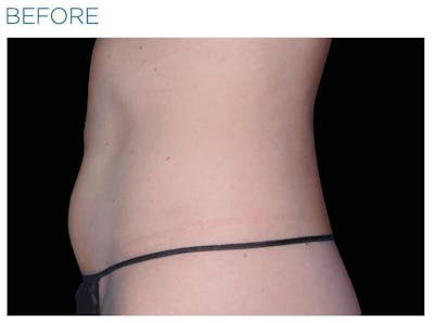 Emsculpt Abdomen Before & After Gallery - Patient 206750 - Image 1