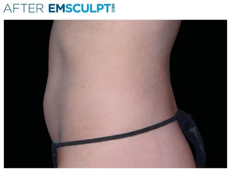 Emsculpt Abdomen Before & After Gallery - Patient 206750 - Image 2
