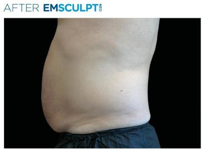 Emsculpt Abdomen Before & After Gallery - Patient 191878 - Image 2