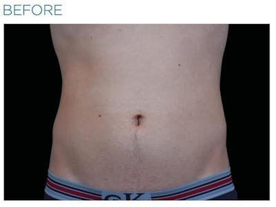 Emsculpt Abdomen Before & After Gallery - Patient 296295 - Image 1