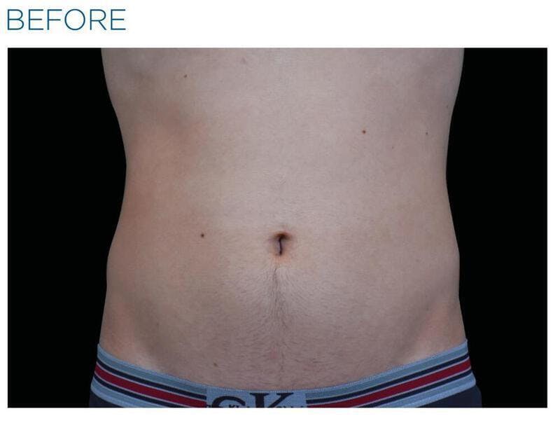 Emsculpt Abdomen Before & After Gallery - Patient 296295 - Image 1