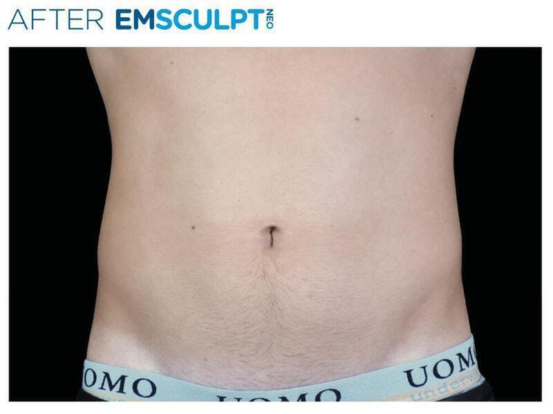 Emsculpt Abdomen Before & After Gallery - Patient 296295 - Image 2