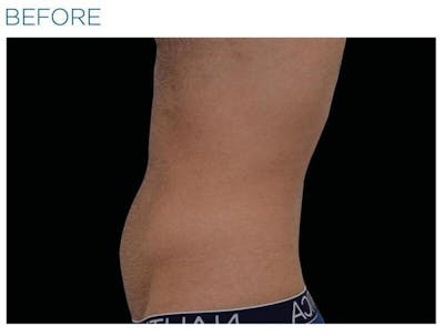 Emsculpt Abdomen Before & After Gallery - Patient 111355 - Image 1