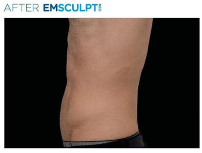 Emsculpt Abdomen Before & After Gallery - Patient 111355 - Image 2