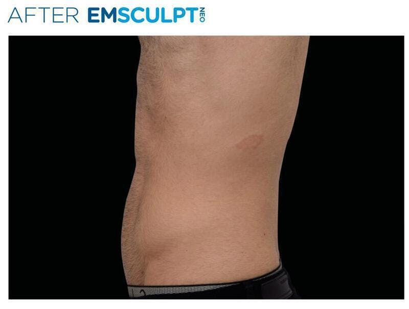 Emsculpt Abdomen Before & After Gallery - Patient 111355 - Image 2