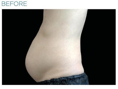 Emsculpt Abdomen Before & After Gallery - Patient 541796 - Image 1