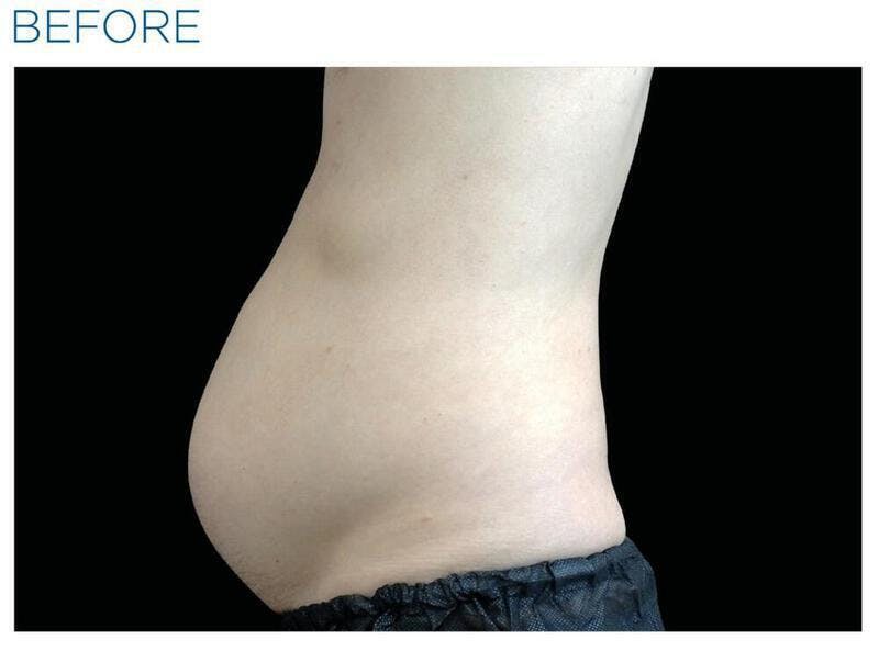 Emsculpt Abdomen Before & After Gallery - Patient 541796 - Image 1