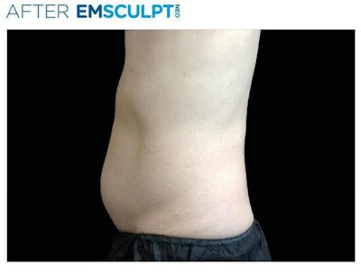 Emsculpt Abdomen Before & After Gallery - Patient 541796 - Image 2