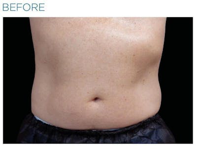 Emsculpt Abdomen Before & After Gallery - Patient 212909 - Image 1