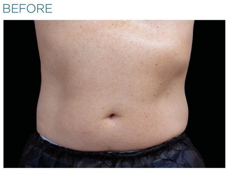 Emsculpt Abdomen Before & After Gallery - Patient 212909 - Image 1