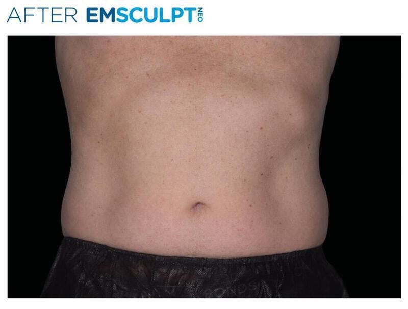 Emsculpt Abdomen Before & After Gallery - Patient 212909 - Image 2
