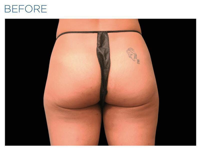 Emsculpt Gluteal Augmentation Before & After Gallery - Patient 343923 - Image 1
