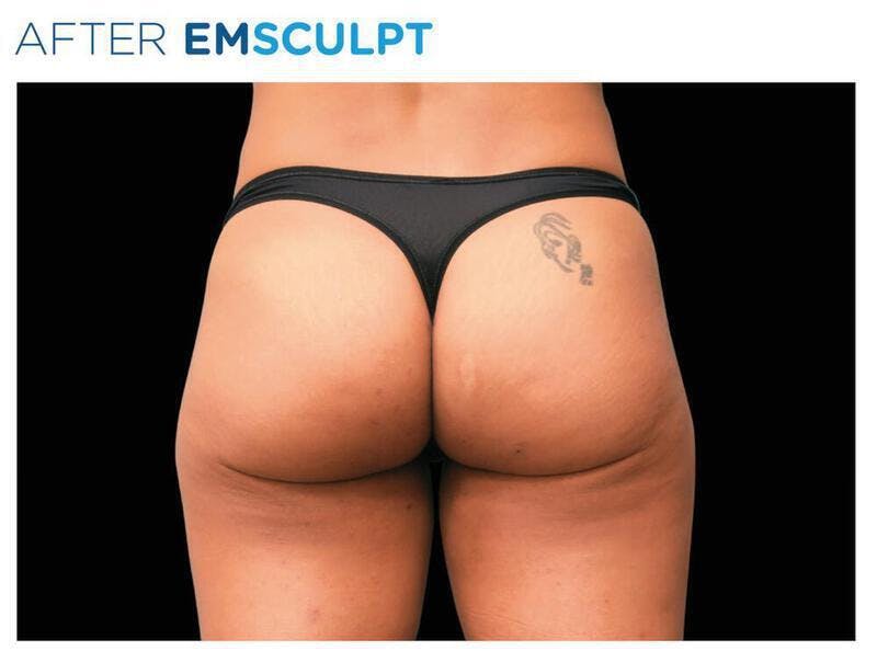 Emsculpt Gluteal Augmentation Before & After Gallery - Patient 343923 - Image 2