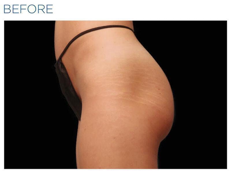 Emsculpt Gluteal Augmentation Before & After Gallery - Patient 299425 - Image 1