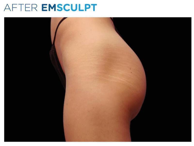 Emsculpt Gluteal Augmentation Before & After Gallery - Patient 299425 - Image 2