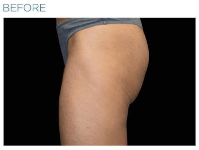 Emsculpt Gluteal Augmentation Before & After Gallery - Patient 243674 - Image 1