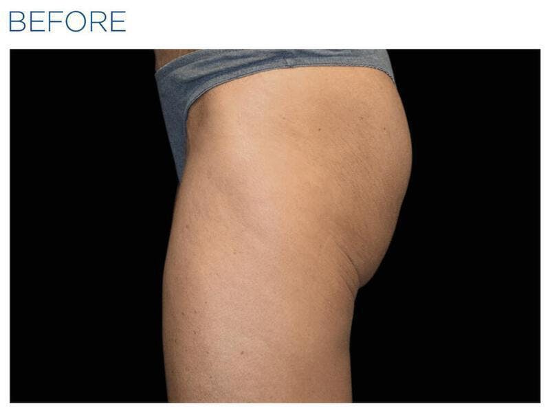 Emsculpt Gluteal Augmentation Before & After Gallery - Patient 243674 - Image 1