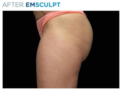 Emsculpt Gluteal Augmentation Before & After Gallery - Patient 243674 - Image 2