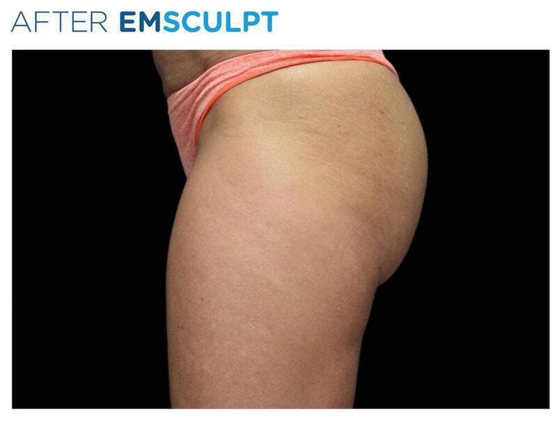 Emsculpt Gluteal Augmentation Before & After Gallery - Patient 243674 - Image 2