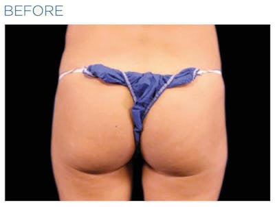 Emsculpt Gluteal Augmentation Before & After Gallery - Patient 247894 - Image 1