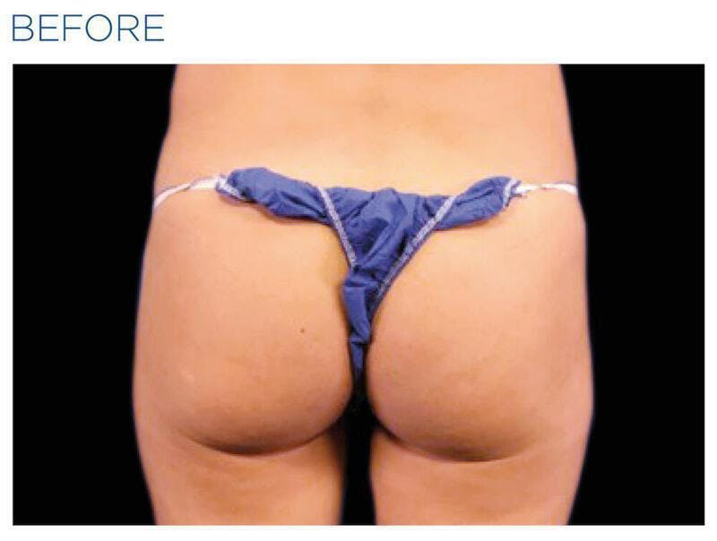 Emsculpt Gluteal Augmentation Before & After Gallery - Patient 247894 - Image 1
