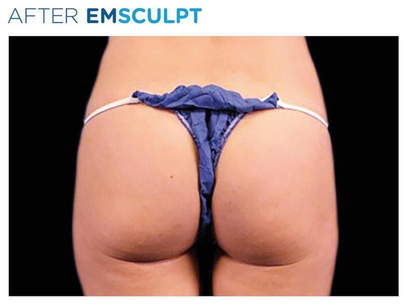 Emsculpt Gluteal Augmentation Before & After Gallery - Patient 247894 - Image 2