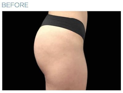 Emsculpt Gluteal Augmentation Before & After Gallery - Patient 287193 - Image 1