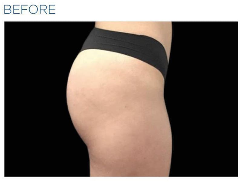 Emsculpt Gluteal Augmentation Before & After Gallery - Patient 287193 - Image 1