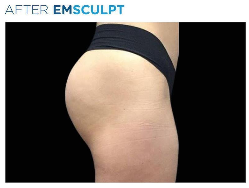 Emsculpt Gluteal Augmentation Before & After Gallery - Patient 287193 - Image 2