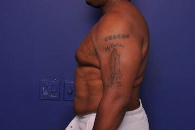 Liposuction Before & After Gallery - Patient 376384 - Image 1