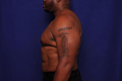 Liposuction Before & After Gallery - Patient 376384 - Image 2