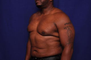 Liposuction Before & After Gallery - Patient 376384 - Image 4