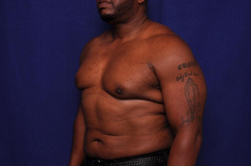 Liposuction Before & After Gallery - Patient 376384 - Image 4