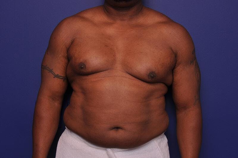 Liposuction Before & After Gallery - Patient 376384 - Image 5
