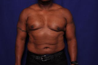 Liposuction Before & After Gallery - Patient 376384 - Image 6