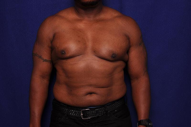 Liposuction Before & After Gallery - Patient 376384 - Image 6