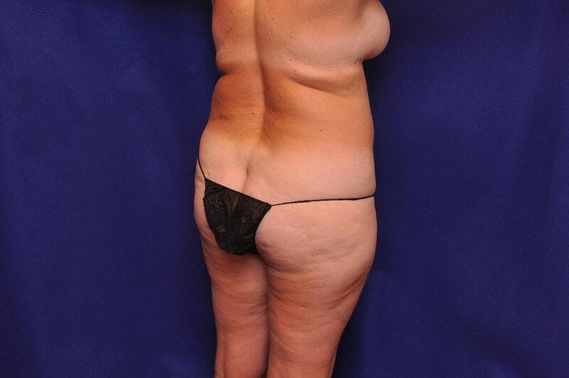 Liposuction Before & After Gallery - Patient 254203 - Image 3