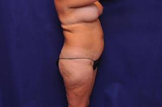 Liposuction Before & After Gallery - Patient 254203 - Image 8