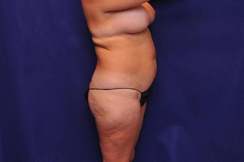 Liposuction Before & After Gallery - Patient 254203 - Image 8