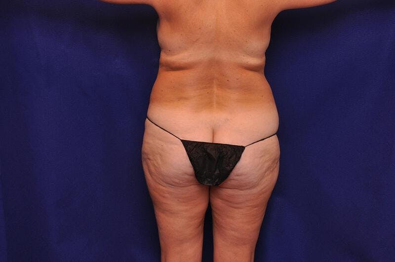 Liposuction Before & After Gallery - Patient 254203 - Image 11